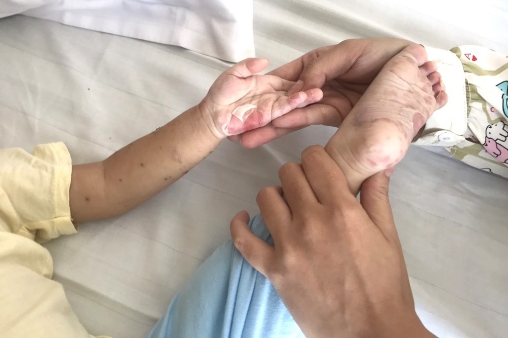 Bé trai 1 tuổi nổi hàng trăm bóng nước, loét miệng lẫn hậu môn vì bệnh hiểm - 2 Bé trai 1 tuổi nổi hàng trăm bóng nước, loét miệng lẫn hậu môn vì bệnh hiểm - 2