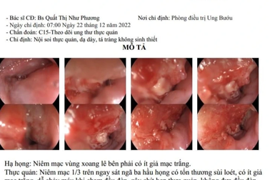 Nam bệnh nhân bất ngờ phát hiện ung thư thực quản sau nuốt nghẹn, giảm 4kg