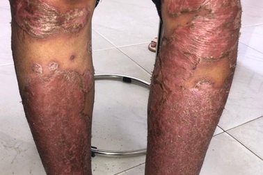 Tự điều trị vảy nến, nữ bệnh nhân lở loét toàn thân
