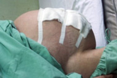 Bóc thành công khối u 12kg trong ổ bụng