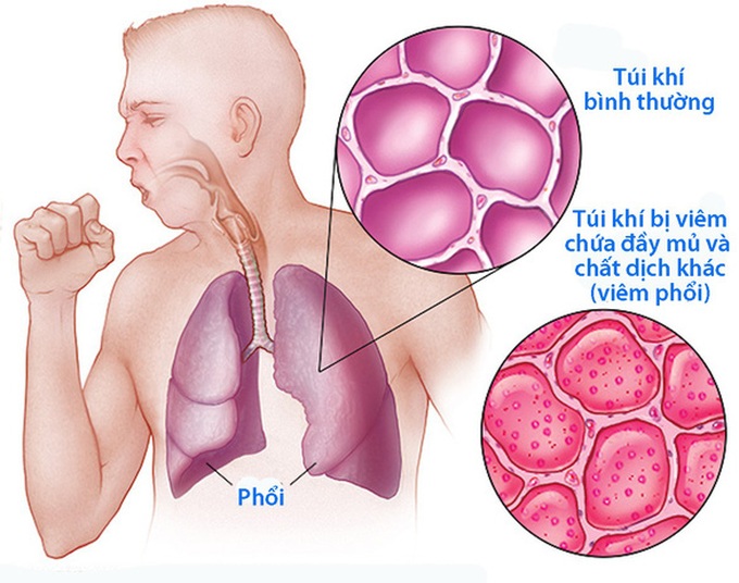 Phế cầu khuẩn thường trú tại đường thở của mỗi người, khi cơ thể bị giảm sức đề kháng, cảm lạnh, phế cầu khuẩn sẽ bùng phát lên và gây bệnh.