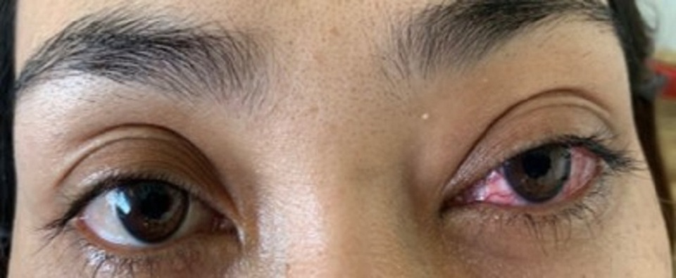 Tưởng đau mắt đỏ, bệnh nhân suýt mù vì bệnh lý hiếm gặp - 3 Tưởng đau mắt đỏ, bệnh nhân suýt mù vì bệnh lý hiếm gặp - 3