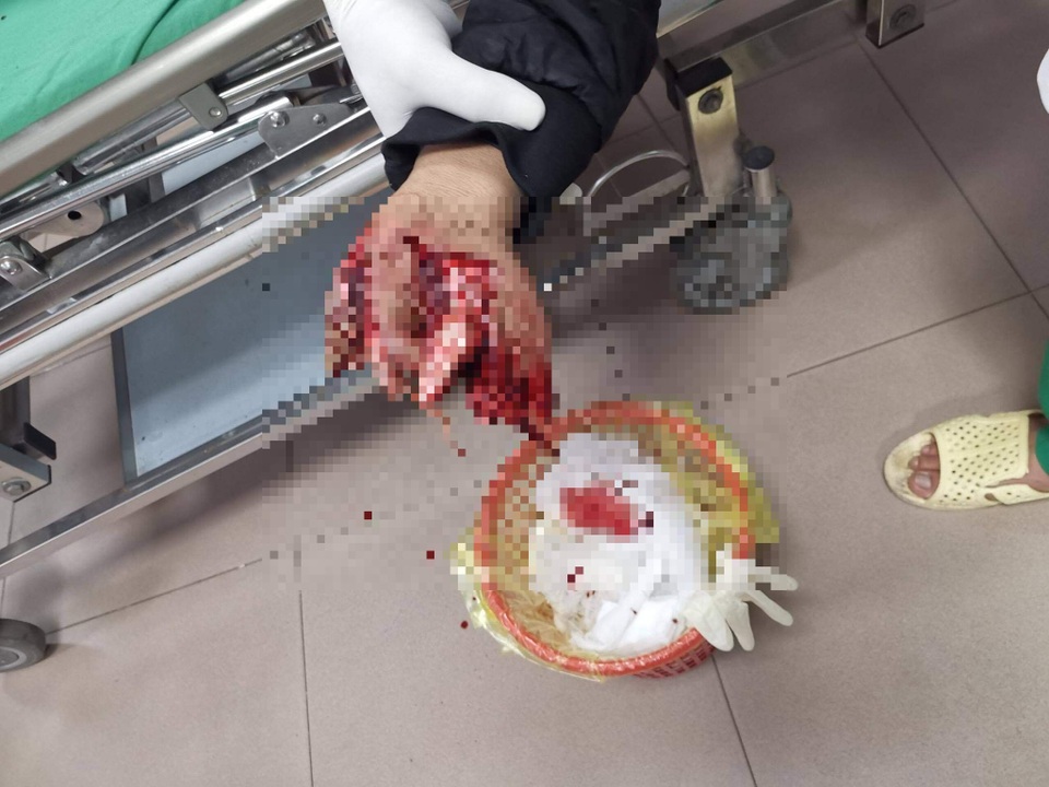 Nghịch pháo, 2 anh em bị thương nát tay, rách mặt - 2 Nghịch pháo, 2 anh em bị thương nát tay, rách mặt - 2