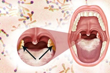 Bắc Giang phát hiện thêm một ca dương tính với bạch hầu