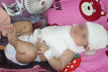 Căn bệnh "hiểm" do sang chấn sản khoa, khiến cháu bé vừa sinh đã liệt tay