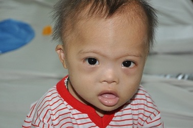 Em bé dân tộc Dáy đang trong tình trạng nguy kịch