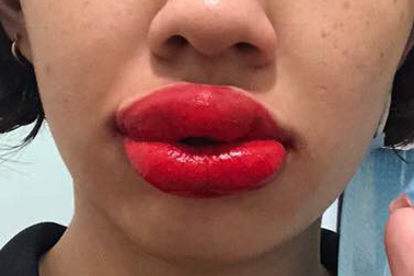 Nhiều người biến dạng mặt, nhiễm trùng tay chân nặng vì đi xăm và xóa xăm