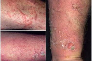 Cảnh báo mới về sự nguy hiểm của kiến ba khoang