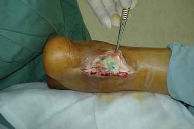 Tiêm thuốc giảm đau, cụ ông bị đứt gân chân