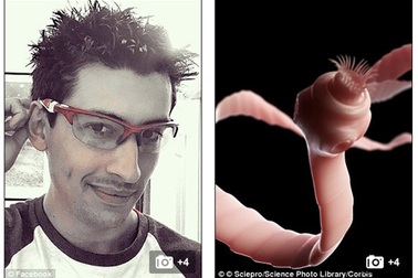 Đau nửa đầu dữ dội vì… sán làm ổ trong não