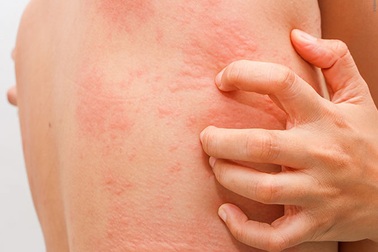 Giải pháp thoát khỏi những “cơn ngứa điên cuồng” của bệnh nổi mề đay