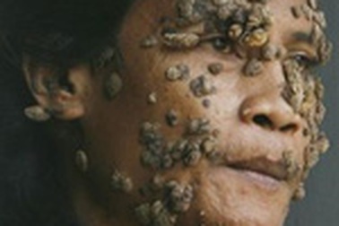 “Người cây” được tạm thời xuất viện