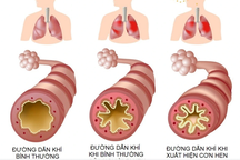 4.000 người Việt tử vong mỗi năm vì hen phế quản