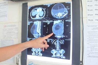 Phẫu thuật khối u buồng trứng nặng hơn 6kg