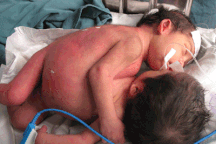 “Cặp song sinh dính nhau rất phức tạp”