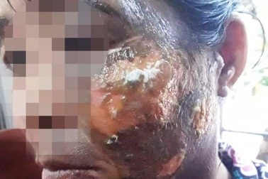 Chồng hắt cả ấm nước sôi vào mặt vợ vì không để cơm cho mình