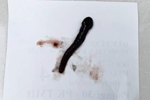 Gắp con đỉa sống trong mũi bé gái 8 tuổi