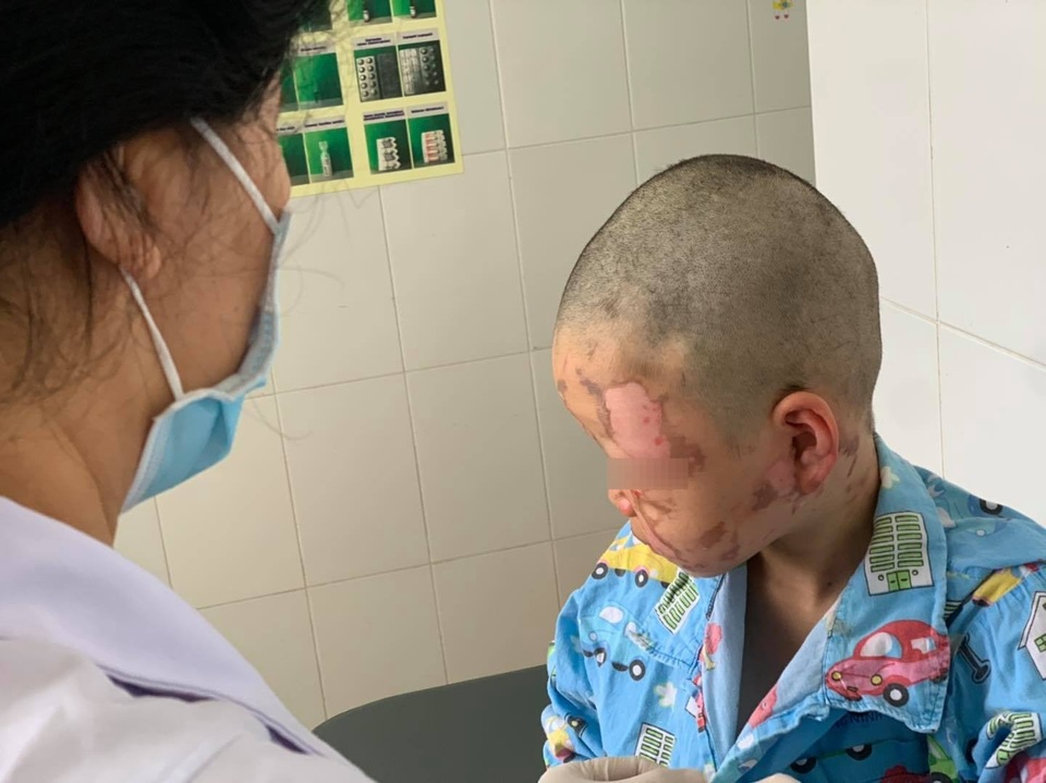 Bé 10 tuổi bỏng nặng vùng mặt vì nghịch dại theo video trên mạng - 1 Bé 10 tuổi bỏng nặng vùng mặt vì nghịch dại theo video trên mạng - 1