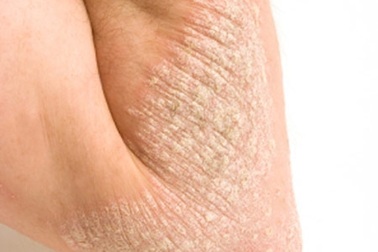 Những hiểu lầm về bệnh vẩy nến