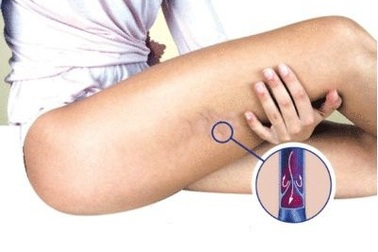 6 báo hiệu cơ thể có cục máu đông