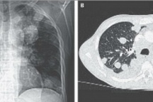 Phát hiện sốc: Ung thư di căn từ… sán