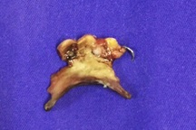 Đang uống nước bị sặc, hàm răng giả trôi vào cổ họng người đàn ông