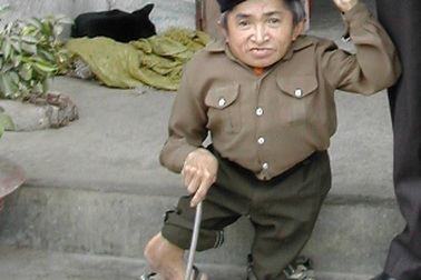 Chuyện về người lùn nhất Việt Nam