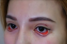 6 tháng tồi tệ của cô gái Bến Tre bị đuổi việc, suýt mù vì đi cắt mí ở spa