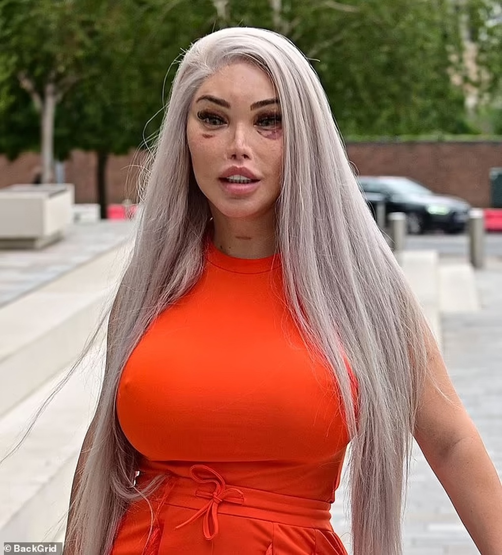Sao chuyển giới Jessica Alves lộ diện sau ca thẩm mỹ lần thứ 90 - 2 Sao chuyển giới Jessica Alves lộ diện sau ca thẩm mỹ lần thứ 90 - 2