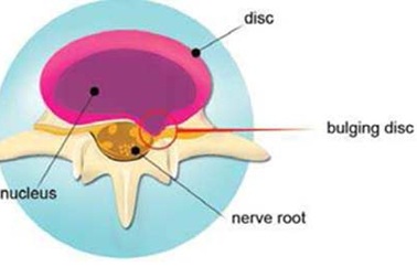 Điều trị đau cột sống cổ và lưng bằng phương pháp Nucleoplasty 