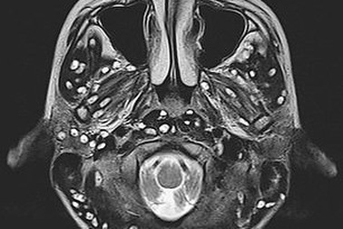 Rùng mình với ấu trùng sán chi chít trong não do ăn thịt lợn chưa nấu chín