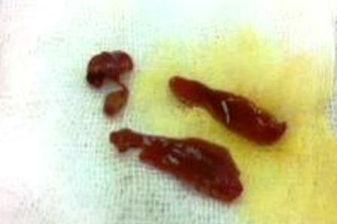 Gắp 3 con sán lá gan lớn trong đường mật