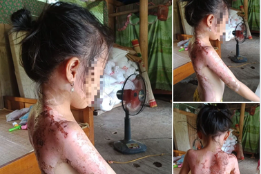 Bị hàng xóm hắt nước sôi, bé 7 tuổi bỏng nặng