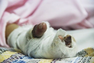 Bé 5 tuổi bị "cháy" nhiều ngón tay vì cắm dây vào ổ điện