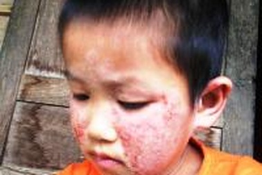 Bé 7 tuổi mất ăn mất ngủ vì căn bệnh "lạ" hành hạ