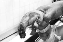 Vụ gia đình bị ném bom xăng: Bé trai 3 tuổi bỏng rất nặng