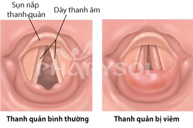 Chấm dứt nỗi lo viêm thanh quản
