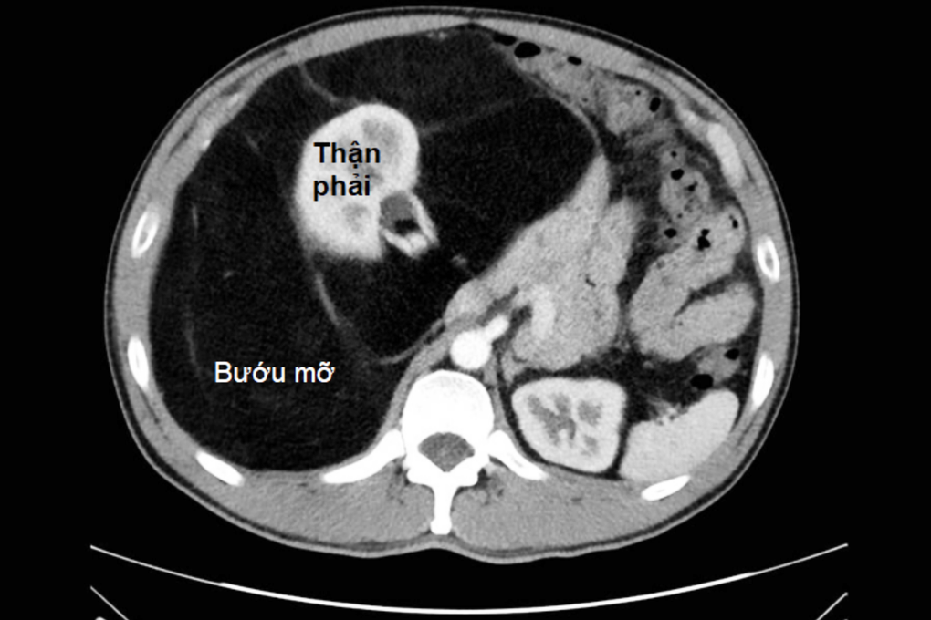 Nhiều người suýt chết vì tưởng bụng bia - 1 Nhiều người suýt chết vì tưởng bụng bia - 1