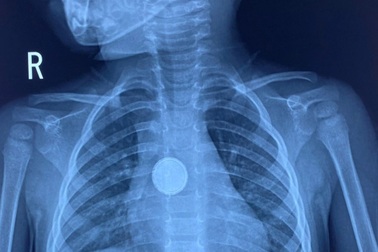 Gắp thành công viên "pin cúc" từ thực quản bé gái 3 tuổi