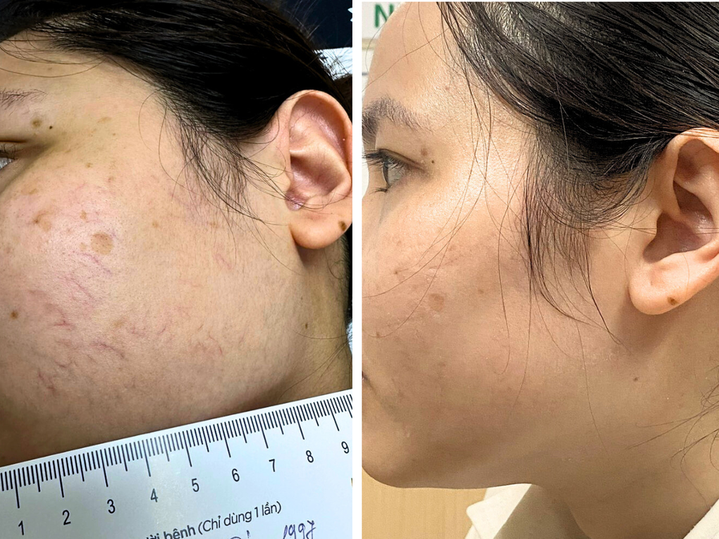 Điều trị giãn tĩnh mạch: Bác sĩ chia sẻ nguyên nhân gây tái phát ít ai ngờ - 3 Điều trị giãn tĩnh mạch: Bác sĩ chia sẻ nguyên nhân gây tái phát ít ai ngờ - 3