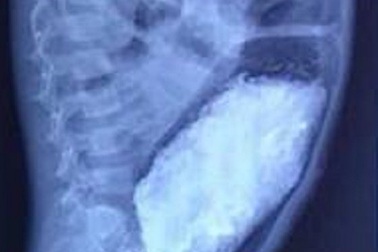 Bị táo bón kéo dài, 3kg phân đóng trong ruột bé trai 5 tuổi