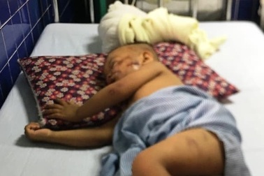 Bị chó becgie nặng 38 kg tấn công, bé trai 2 tuổi nhập viện cấp cứu