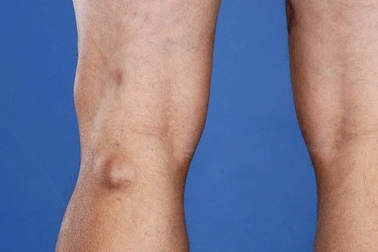 Khớp gối đột nhiên căng phồng: Cảnh giác với căn bệnh này