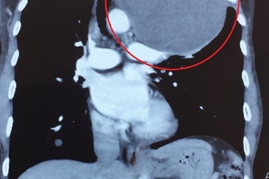 Nam bệnh nhân mang khối u to như quả bóng trong lồng ngực