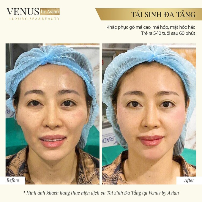 Trẻ ra 10 tuổi xuân chỉ sau 60 phút bằng Tái sinh đa tầng tại Venus by Asian. - Ảnh 2.