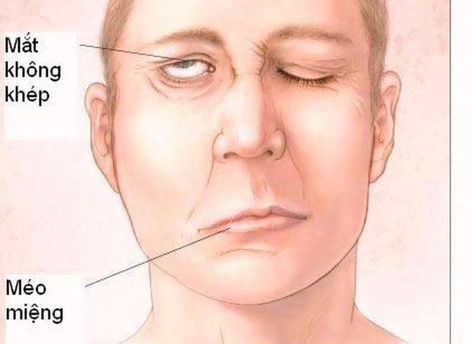 Giữ ấm trong ngày lạnh để phòng ngừa liệt mặt, méo miệng - Ảnh 1.