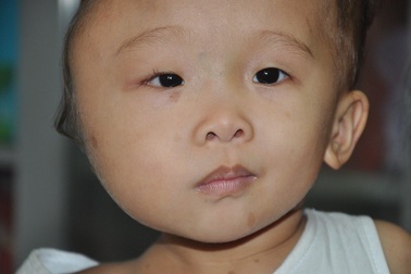 Bị u màng nhện, bé 2 tuổi mang khuôn mặt lệch to bất thường