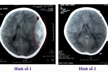 Trẻ 2 tuổi chấn thương sọ não vì ngã từ giường xuống đất
