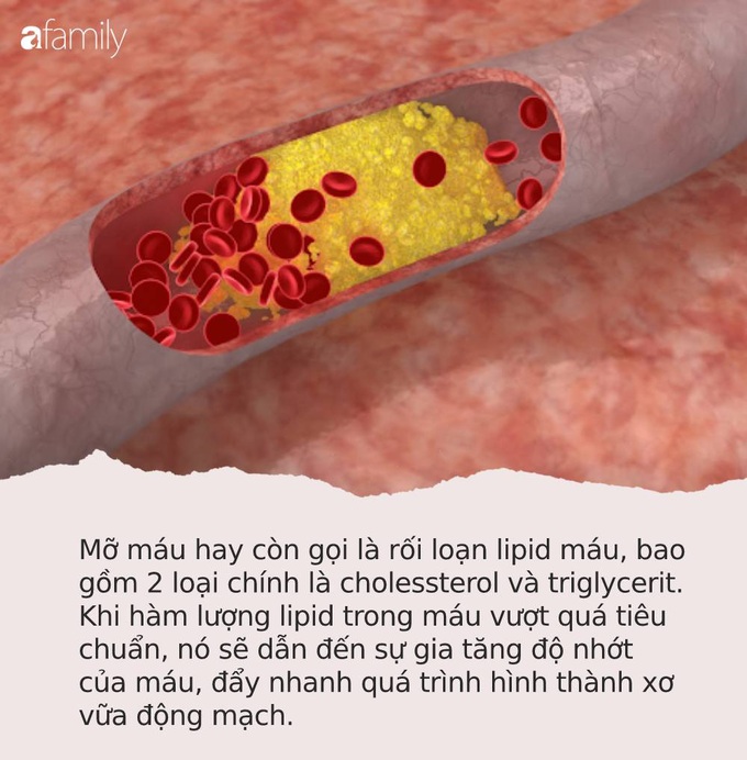 Cứ nhắm mắt ngủ cơ thể lại phản ứng theo những cách này chứng tỏ bạn đang có nhiều mỡ máu, cần phải khẩn trương đi khám - Ảnh 1.