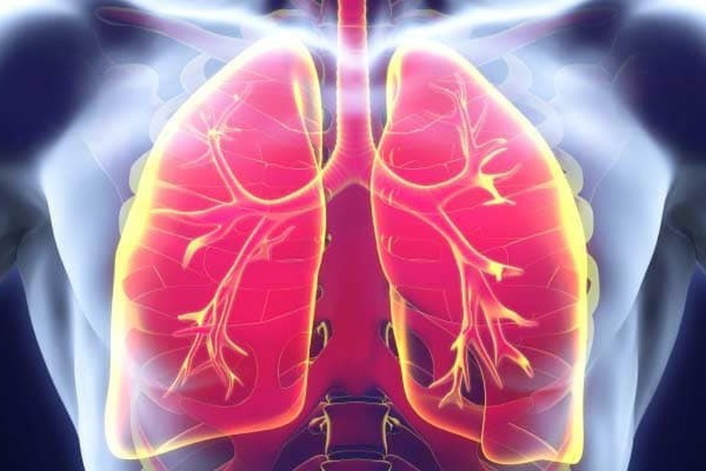 Nguyên nhân của ung thư phổi di căn - 1 Nguyên nhân của ung thư phổi di căn - 1